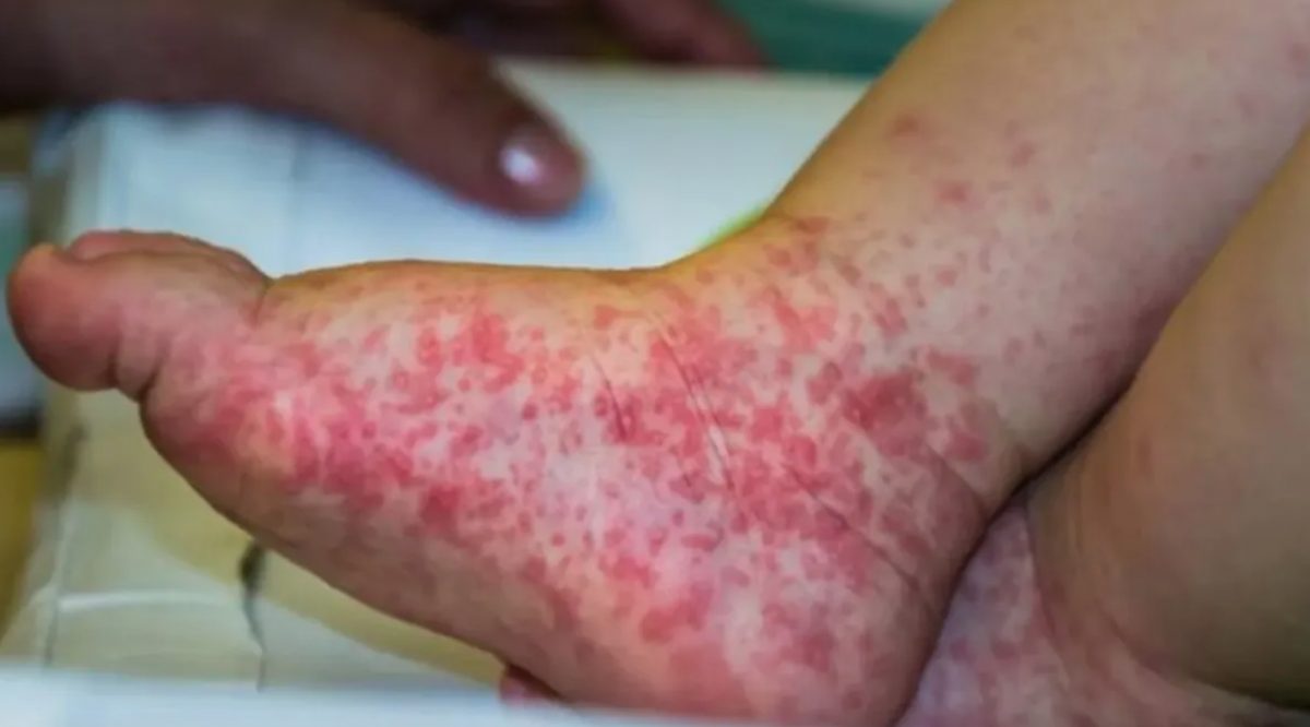 Noticia: En alerta por la gripe del tomate, un nuevo virus que apareció en India En alerta por la gripe del tomate, un nuevo virus que apareció en India