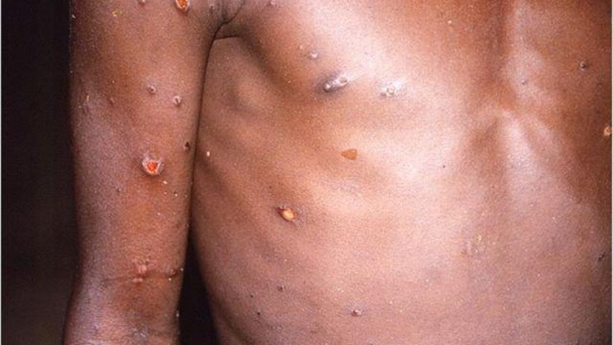 Noticia: Ministerio de Salud analiza primer caso sospechoso de la viruela del mono en el país Ministerio de Salud analiza primer caso sospechoso de la viruela del mono en el país