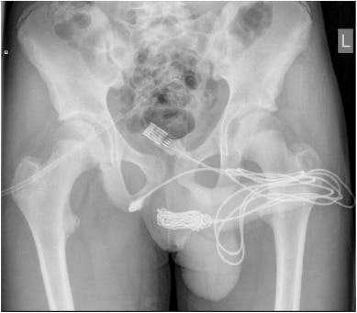 Noticia: Un cable de USB se quedó atrapado en su uretra al tratar de medir sus partes íntimas Un cable de USB se quedó atrapado en su uretra al tratar de medir sus partes íntimas
