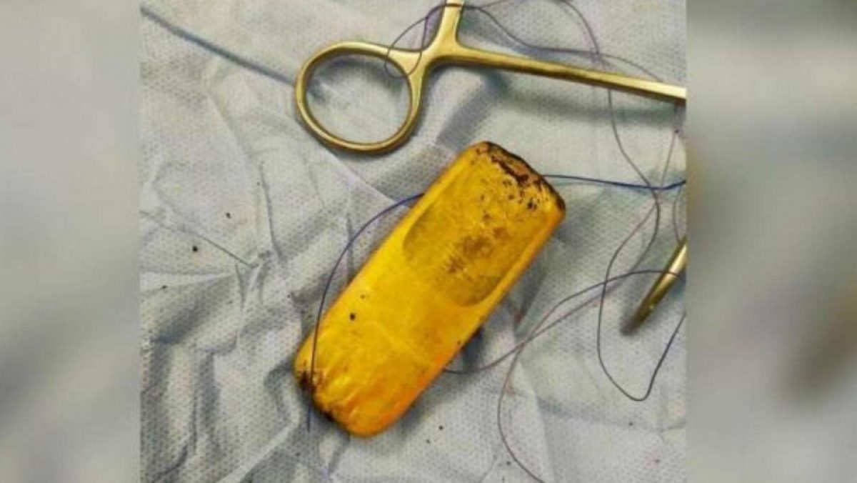 Noticia: Tenía un fuerte dolor y descubrieron un celular en su intestino Tenía un fuerte dolor y descubrieron un celular en su intestino