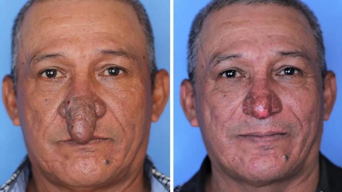 Noticia: Médico operó la nariz de un hombre que sufrió compleja malformación Médico operó la nariz de un hombre que sufrió compleja malformación