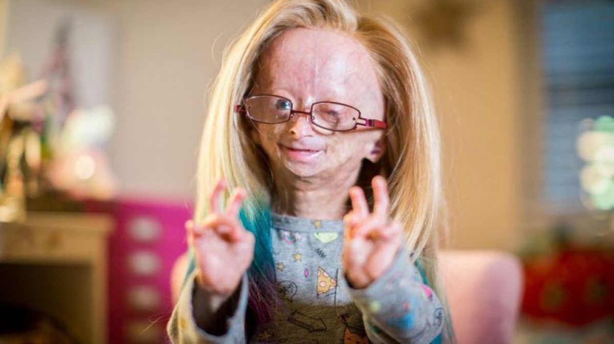 Noticia: Falleció Adalia Rose Williams, la youtuber que inspiró la película de Benjamin Button Falleció Adalia Rose Williams, la youtuber que inspiró la película de Benjamin Button