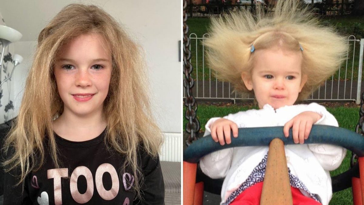 Noticia: Así es la vida de una niña diagnosticada con el síndrome del cabello impeinable Así es la vida de una niña diagnosticada con el síndrome del cabello impeinable