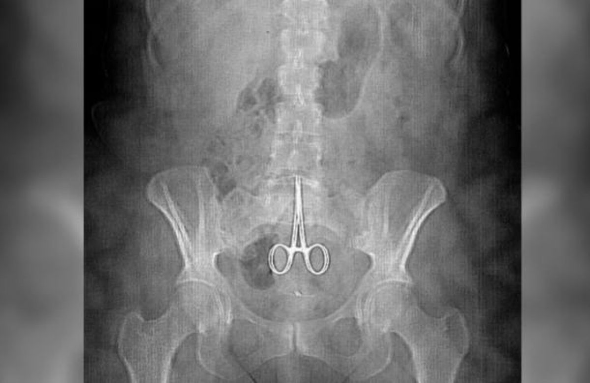 Noticia: Hombre muere después que los médicos le dejaran unas tijeras dentro de su estómago Hombre muere después que los médicos le dejaran unas tijeras dentro de su estómago