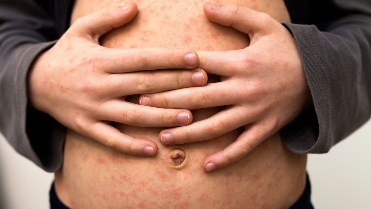 Noticia: Ecuador vacunará a más de 3 millones de niños contra el sarampión, rubéola y polio Ecuador vacunará a más de 3 millones de niños contra el sarampión, rubéola y polio