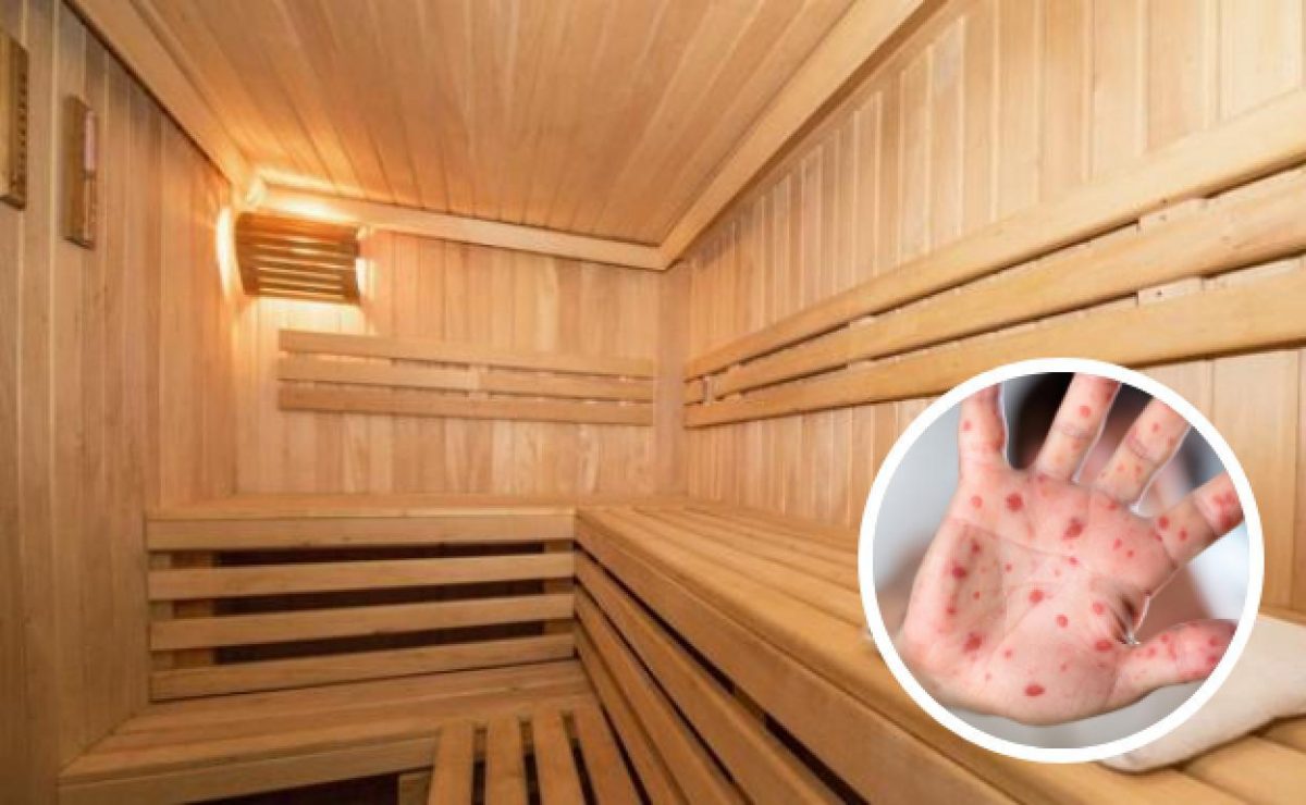 Noticia: En España cierran sauna que sería foco de transmisión de la viruela del mono en ese país En España cierran sauna que sería foco de transmisión de la viruela del mono en ese país