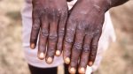 Noticia: Francia confirma 16 casos de viruela del mono en el país Francia confirma 16 casos de viruela del mono en el país