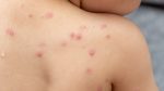 Imagen: Se registran más de 550 contagios de la viruela del mono en Perú Imagen: Se registran más de 550 contagios de la viruela del mono en Perú