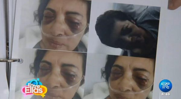 Una mujer se queda ciega tras someterse a operación por quitarse las ojeras