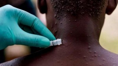 Imagen de Ministerio de Salud Pública activa alerta epidemiológica por viruela del Simio
