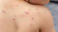 Noticia: Se registran más de 550 contagios de la viruela del mono en Perú Se registran más de 550 contagios de la viruela del mono en Perú