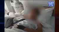 Noticia: VIDEO | Niño atacado por un perro ha sido intervenido quirúrgicamente cuatro veces VIDEO | Niño atacado por un perro ha sido intervenido quirúrgicamente cuatro veces