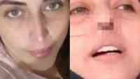 Noticia: Mujer pierde el cartílago nasal tras realizarse una prueba PCR de Covid-19 Mujer pierde el cartílago nasal tras realizarse una prueba PCR de Covid-19